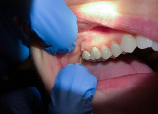 Best Emergency Root Canal Treatment in Muscle Shos, AL
